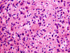 Tumefactive demyelination, H&E x 400