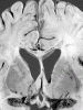 Machiafava-Bignami disease,Coronal sectioned through basal ganglia and cerebrum