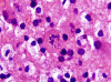 Tumefactive demyelination, Creutzfeldt-Peters cell