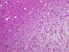  Tumefactive demyelination, lesion/brain interface, medium power H&E stain slide