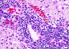 Tumefactive demyelination, high power H&E stained slide demonstrating perivascular inflammation