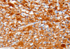 Tumefactive demyelination, immunohistochemical staining for glial fibrillary acidic protein