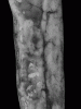 Longitudinally extensive transverse myelitis, ventral surface of cervical spinal cord