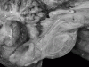 Longitudinally extensive transverse myelitis, extending into caudal brainstem, mid sagittal section of brain