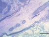 Axon entering demyelinative plaque, ultrastructural section