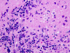 Optic Neuritis, H&E stain x400