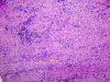 Optic Neuritis, H&E stain x100