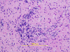 Optic Neuritis, H&E stain x200