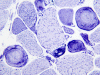 Ring fibers, NADH-TR histochemical staining