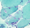 Inclusion body myositis, Gomori trichrome stained frozen muscle x 200