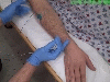 Extensor Carpi Ulnaris EMG Technique