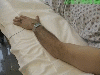 Extensor Pollicis Longus EMG Technique